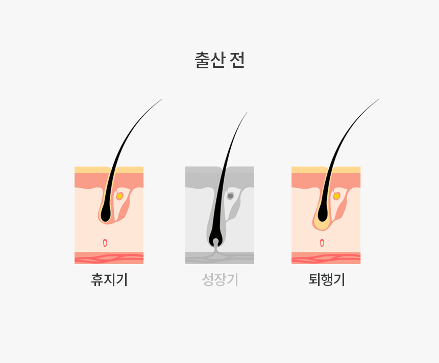 240628-A1_hair_loss_common_06.gif